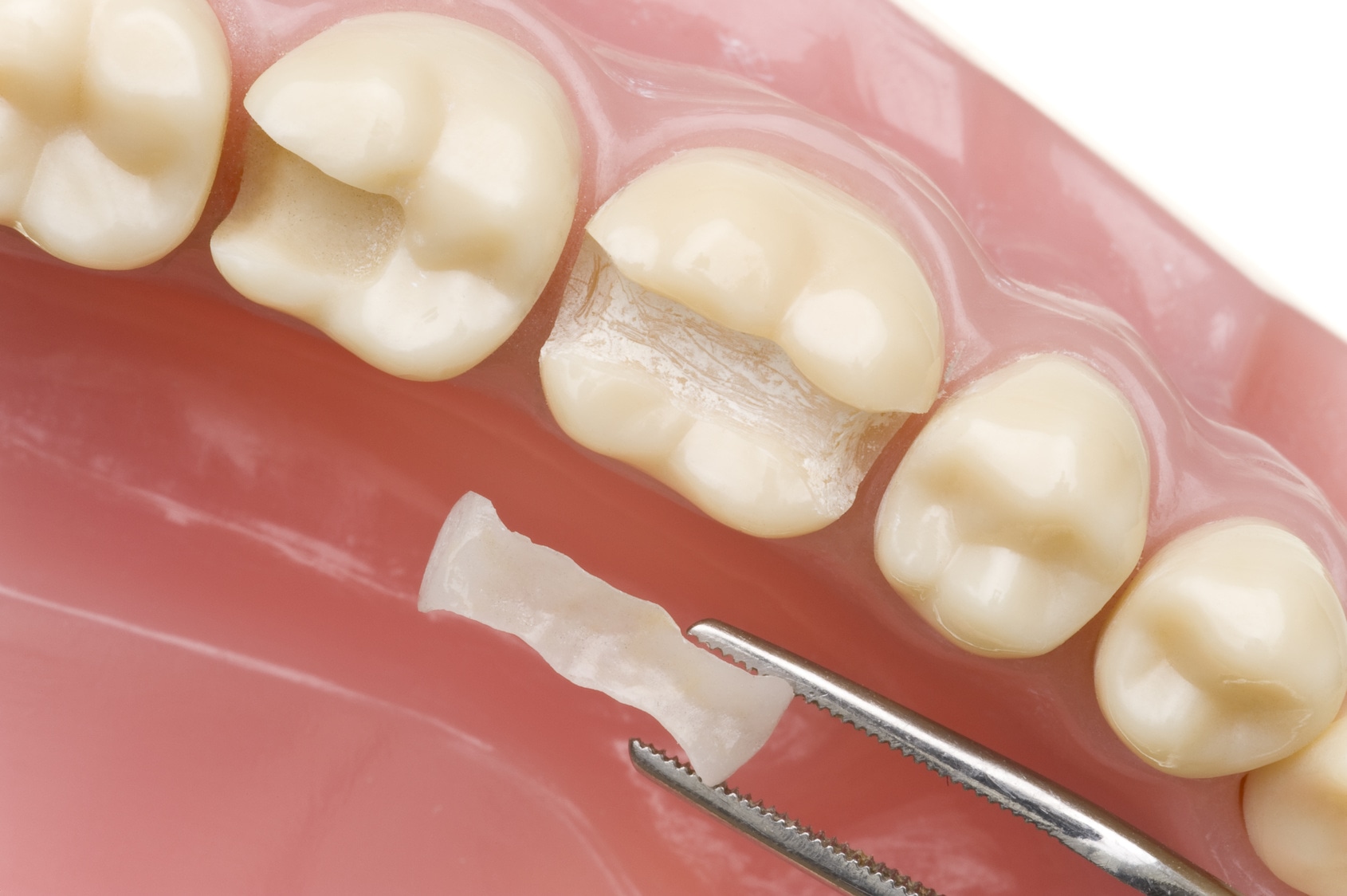 Реставрация зубов керамическими вкладками | Стоматология в Химках | Стоматология Кантри Парк
