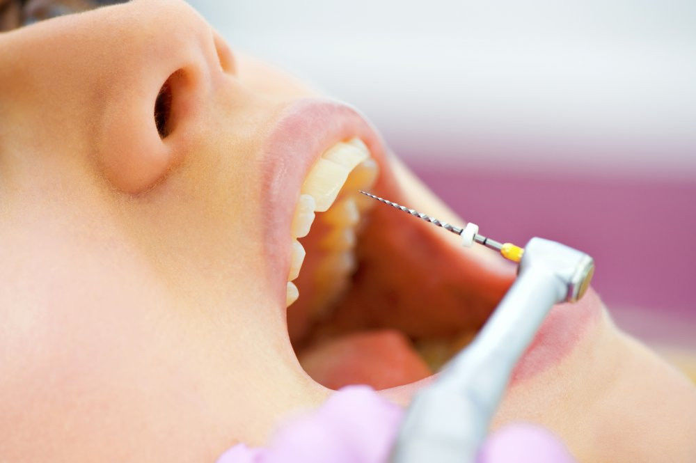 Пломбировка каналов зубов | Стоматология в Химках | Стоматология Кантри Парк