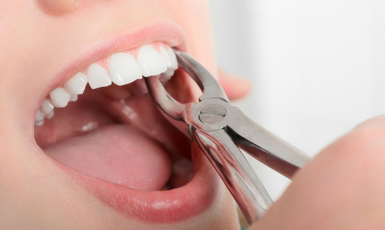 Простое и сложное удаление зуба | Стоматология в Химках | Стоматология Кантри Парк
