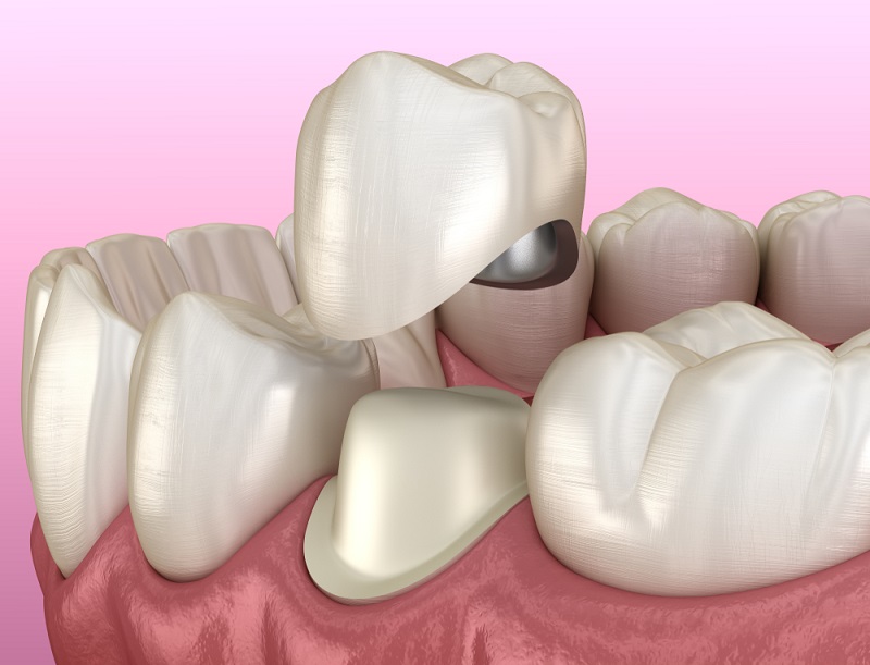 Металлокерамические коронки на передние зубы | Стоматология в Химках | Стоматология Кантри Парк