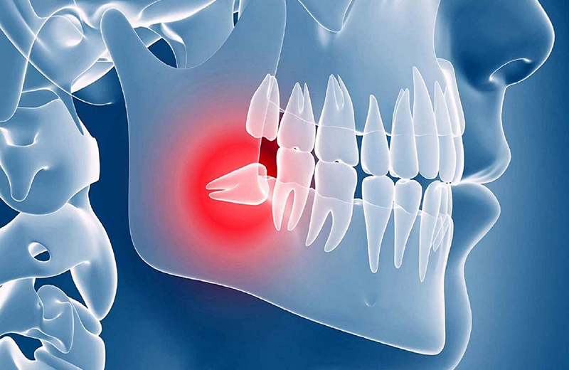 Удаление зуба мудрости | Стоматология в Химках | Стоматология Кантри Парк