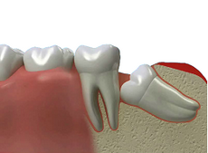 Нужно ли удалять зубы мудрости - Стоматология Химки
