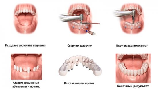Имплантация зубов: описание процесса
