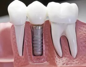 Импланты зубов - как ставят, сколько служат?