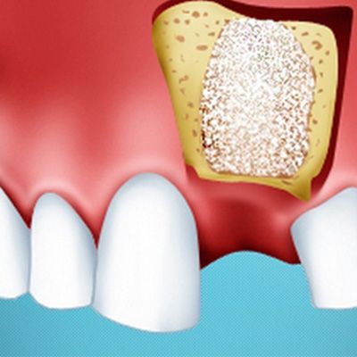 Наращивание костной ткани при имплантации зубов