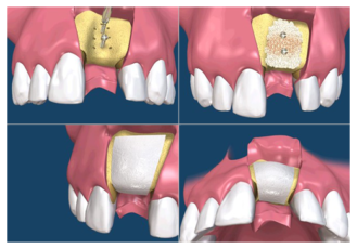 Особенность операций по наращиванию костной ткани при имплантации зубов