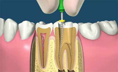 лечение корневого канала Кантри Парк стоматология