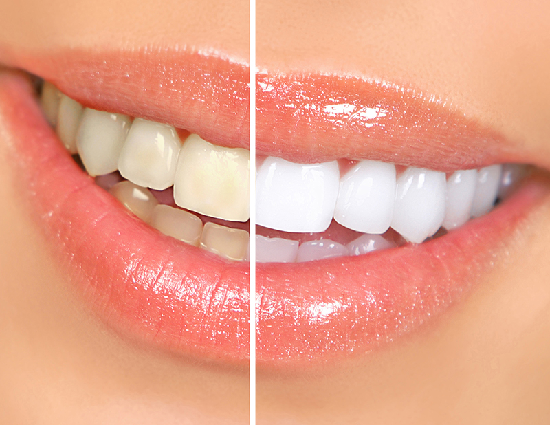  Отбеливание зубов Bleach’n Smile Automix